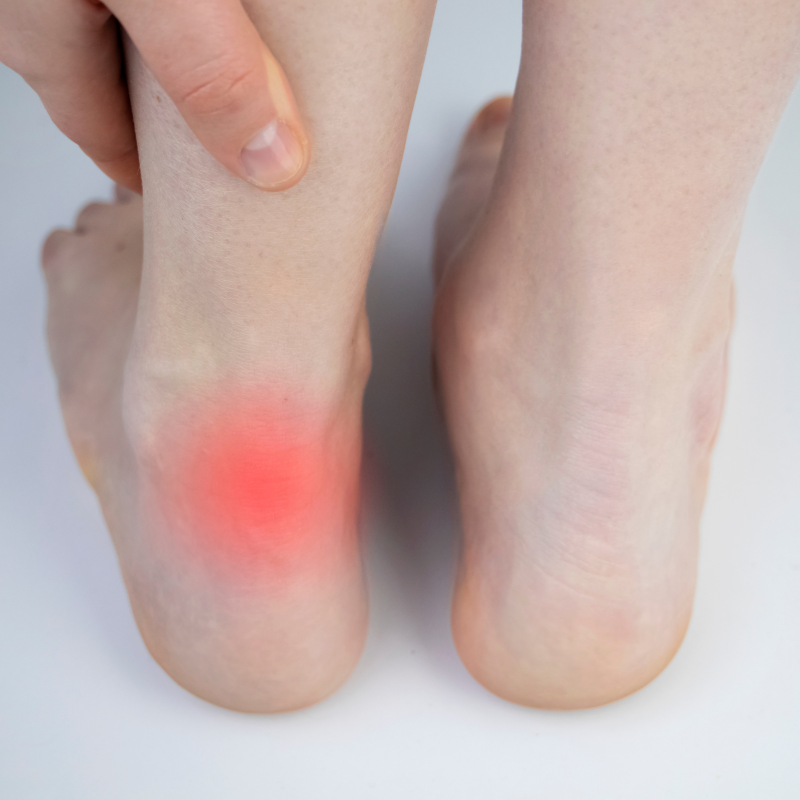 Physiotherapy for Achilles Tendinopathy Plymouth
